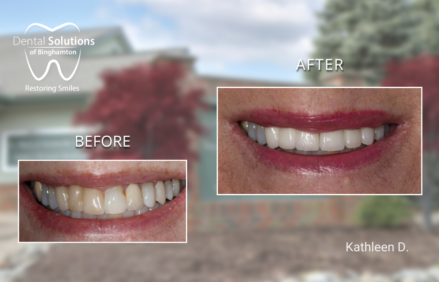 Dental Crowns
