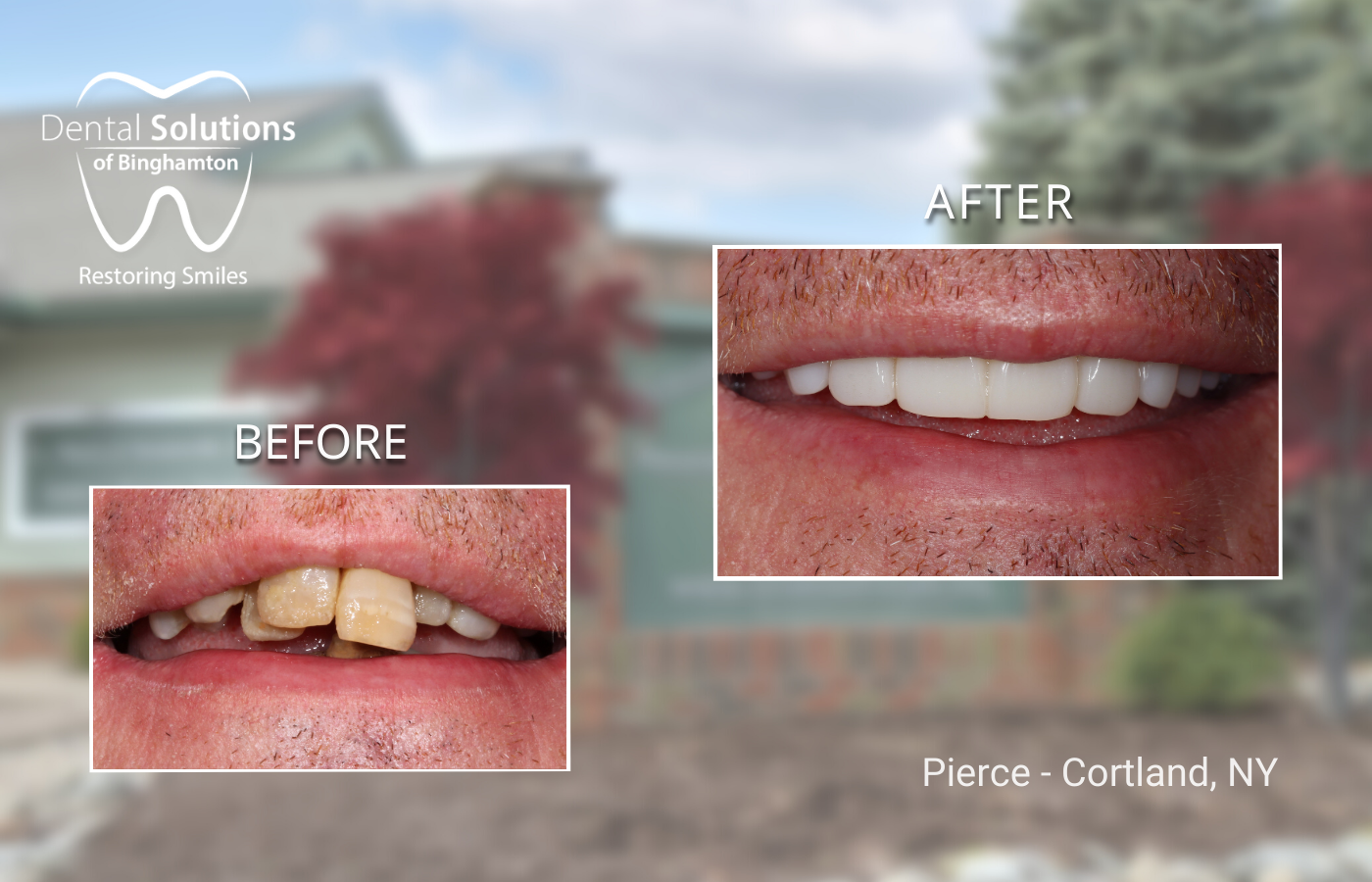 Full Arch Implantd